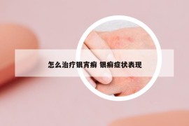 怎么治疗银宵癣 银癣症状表现