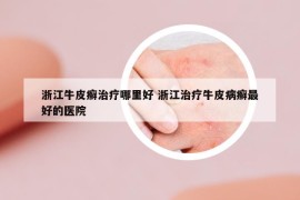 浙江牛皮癣治疗哪里好 浙江治疗牛皮病癣最好的医院