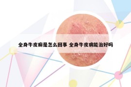 全身牛皮癣是怎么回事 全身牛皮病能治好吗