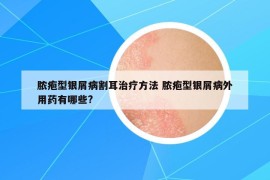 脓疱型银屑病割耳治疗方法 脓疱型银屑病外用药有哪些?