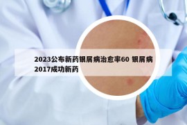 2023公布新药银屑病治愈率60 银屑病2017成功新药