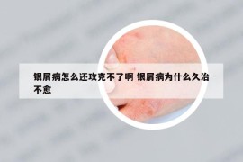 银屑病怎么还攻克不了啊 银屑病为什么久治不愈