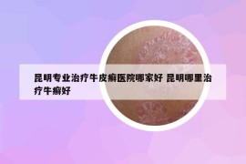 昆明专业治疗牛皮癣医院哪家好 昆明哪里治疗牛癣好