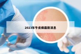 2023年牛皮癣最新消息