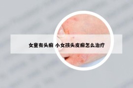 女童有头癣 小女孩头皮癣怎么治疗