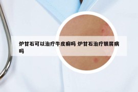 炉甘石可以治疗牛皮癣吗 炉甘石治疗银屑病吗