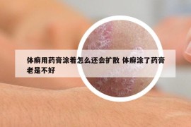 体癣用药膏涂着怎么还会扩散 体癣涂了药膏老是不好