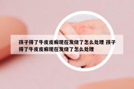 孩子得了牛皮皮癣现在发烧了怎么处理 孩子得了牛皮皮癣现在发烧了怎么处理