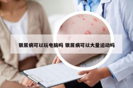 银屑病可以玩电脑吗 银屑病可以大量运动吗