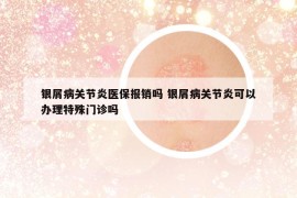 银屑病关节炎医保报销吗 银屑病关节炎可以办理特殊门诊吗