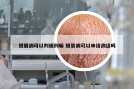 银屑病可以判缓刑嘛 银屑病可以申请病退吗