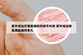 紫外线治疗银屑病如何调节时间 紫外线治银屑病能维持多久