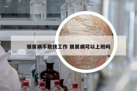 银屑病不敢找工作 银屑病可以上班吗