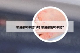 银屑病喝牛奶行吗 银屑病能喝牛奶?