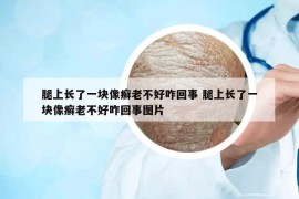 腿上长了一块像癣老不好咋回事 腿上长了一块像癣老不好咋回事图片