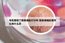 母乳期得了银屑病能打针吗 银屑病哺乳期可以用什么药