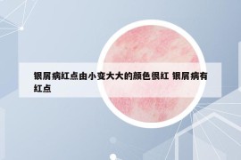 银屑病红点由小变大大的颜色很红 银屑病有红点