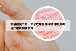 银屑病关节炎一辈子吃甲氨蝶呤吗 甲氨蝶呤治疗银屑病关节炎