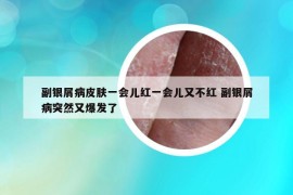 副银屑病皮肤一会儿红一会儿又不红 副银屑病突然又爆发了