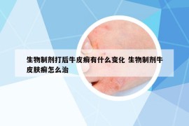 生物制剂打后牛皮癣有什么变化 生物制剂牛皮肤癣怎么治