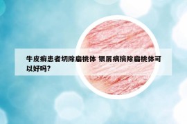 牛皮癣患者切除扁桃体 银屑病摘除扁桃体可以好吗?