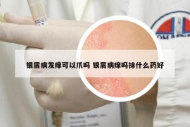 银屑病发痒可以爪吗 银屑病痒吗抹什么药好