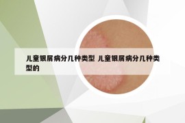 儿童银屑病分几种类型 儿童银屑病分几种类型的