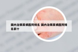 国内治银屑病医院排名 国内治银屑病医院排名前十