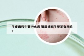 牛皮癣和牛蒡泡水吗 银屑病喝牛蒡茶有用吗?