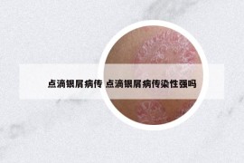 点滴银屑病传 点滴银屑病传染性强吗