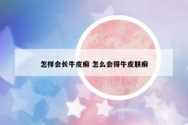 怎样会长牛皮癣 怎么会得牛皮肤癣