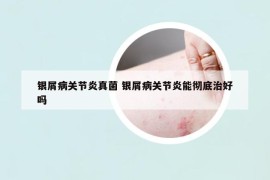 银屑病关节炎真菌 银屑病关节炎能彻底治好吗