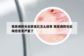 银屑病照光皮肤变红怎么回事 银屑病照光后痒感觉更严重了