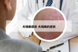 大钱癣症状 大钱癣的症状