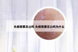 头癣需要忌口吗 头癣需要忌口吗为什么