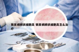 银屑病鳞状细胞高 银屑病鳞状细胞高怎么治疗