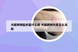 大腿两侧起的是什么癣 大腿两侧长藓怎么消除