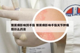 银屑病影响到手指 银屑病影响手指关节肿痛擦什么药膏