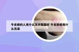 牛皮癣的人用什么洗衣服最好 牛皮肤癣用什么洗澡