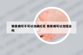 银屑病可不可以泡藏红花 银屑病可以泡瑶浴吗