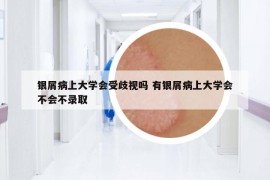 银屑病上大学会受歧视吗 有银屑病上大学会不会不录取