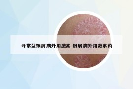 寻常型银屑病外用激素 银屑病外用激素药