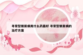 寻常型银屑病用什么药最好 寻常型银屑病的治疗方案