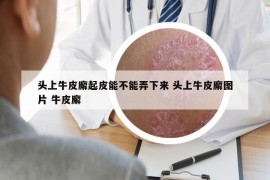 头上牛皮廨起皮能不能弄下来 头上牛皮廨图片 牛皮廨