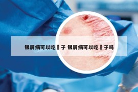 银屑病可以吃栛子 银屑病可以吃栛子吗