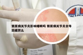 银屑病关节炎影响睡眠吗 银屑病关节炎会导致疲劳么