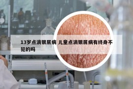 13岁点滴银屑病 儿童点滴银屑病有终身不犯的吗