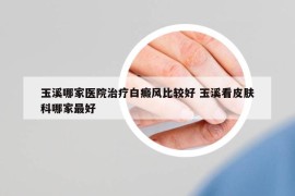 玉溪哪家医院治疗白癜风比较好 玉溪看皮肤科哪家最好