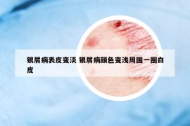 银屑病表皮变淡 银屑病颜色变浅周围一圈白皮