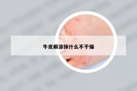 牛皮癣涂抹什么不干燥